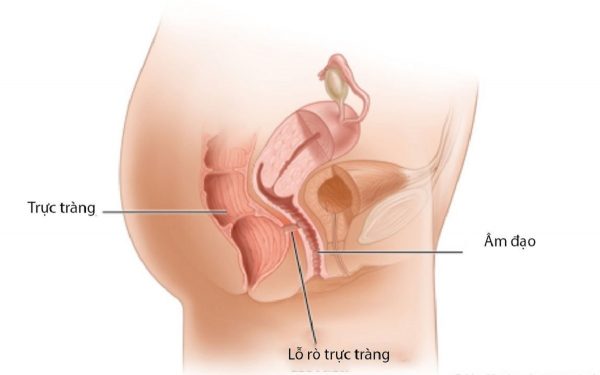 Viên đặt âm đạo