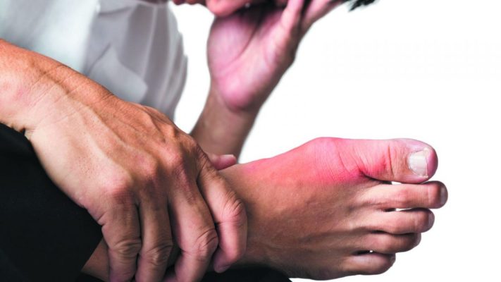 Lưu ý trong điều trị cơn gout cấp